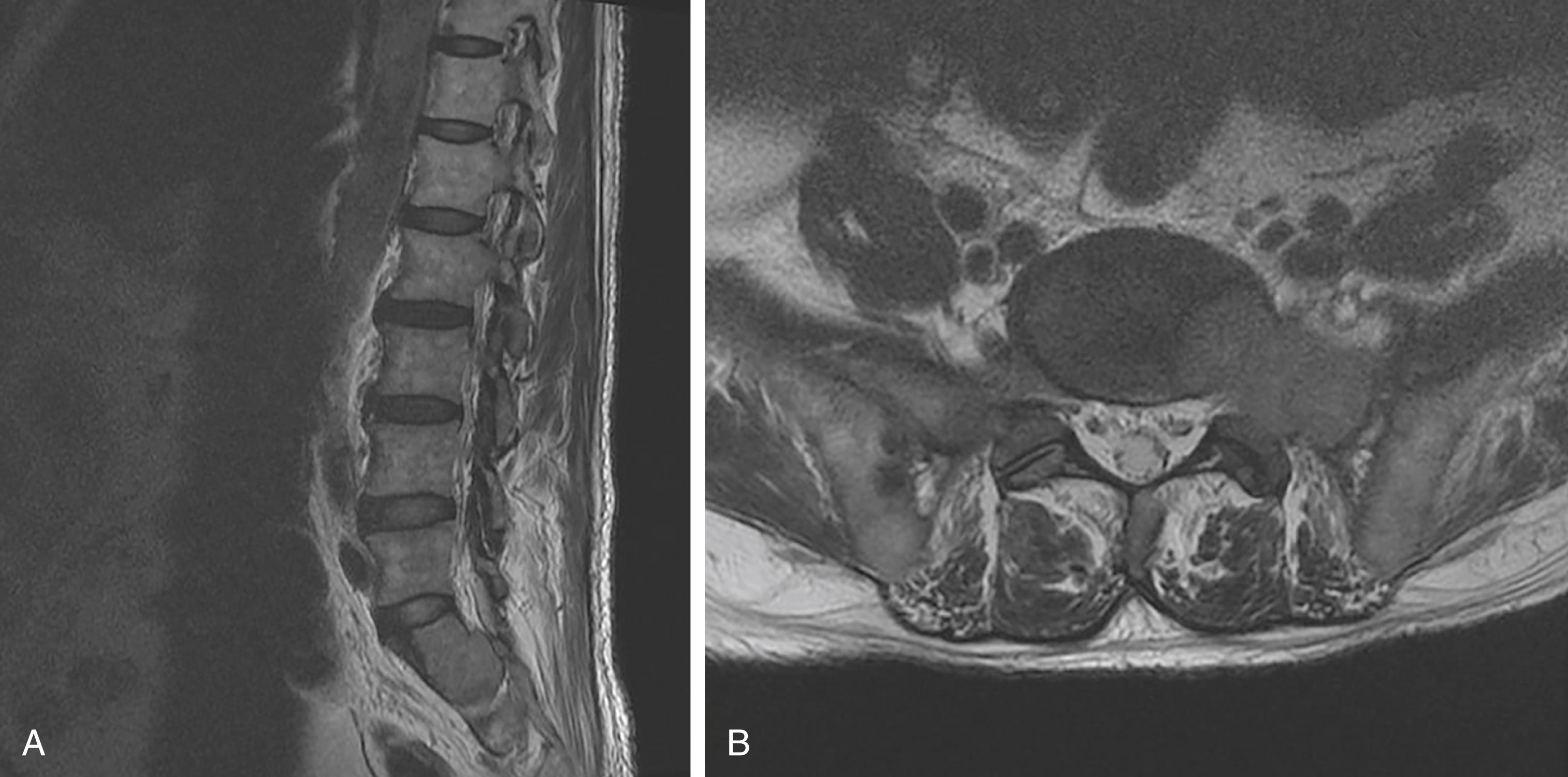 Fig. 158.1, A 69-year-old male patient with a history of hepatocellular carcinoma presented with upper left-sided thigh pain, sharp, radiating down the leg. T2-weighted magnetic resonance imaging from ( A ) sagittal and ( B ) axial views showing expansile metastatic lesion in the left aspect of the sacrum with soft tissue component and cortical breakthrough with extension into left S1 neural foramen.