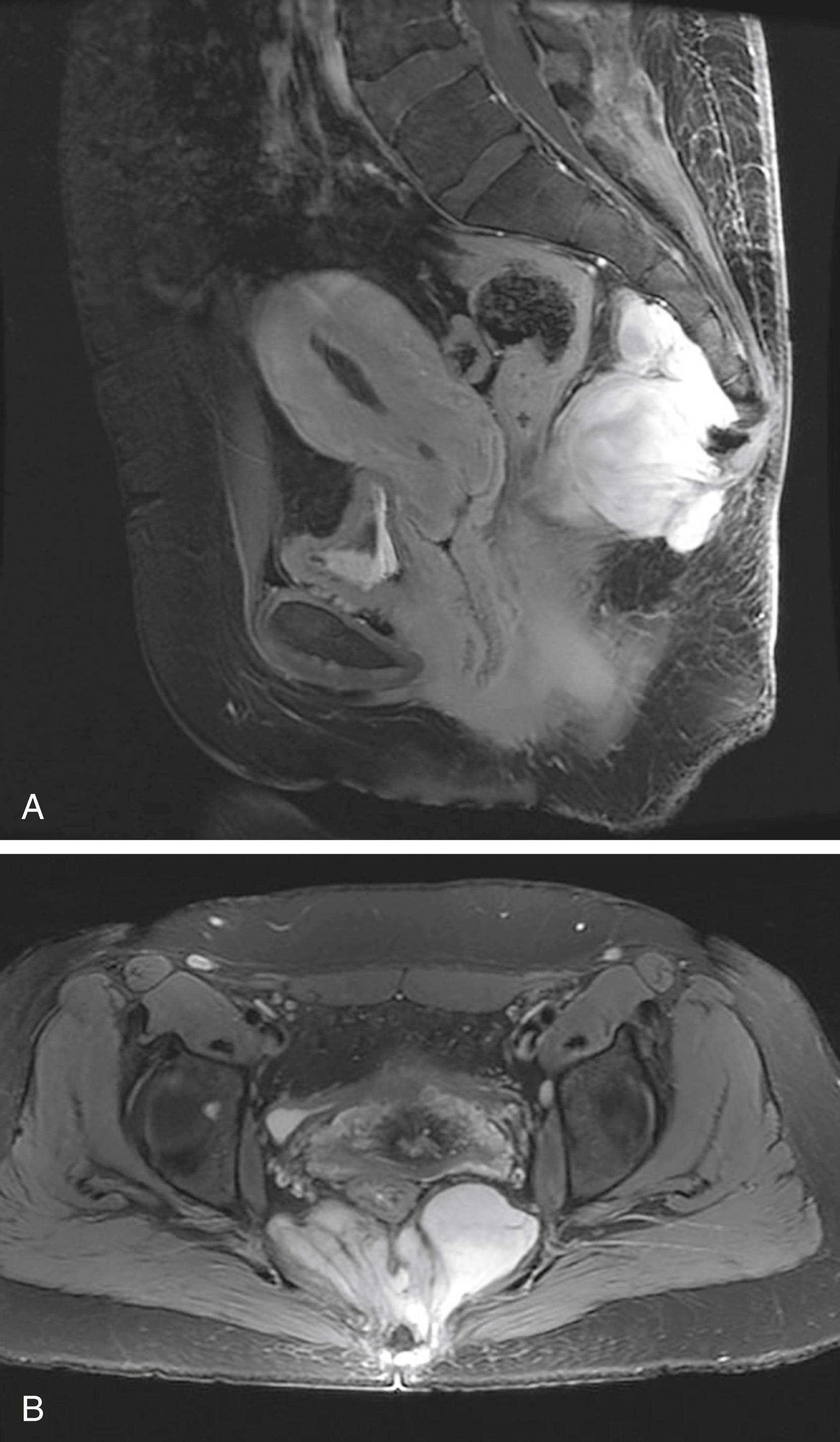 Fig. 158.11, A 42-year-old patient with a longstanding complaint of constipation. The patient was referred for multidisciplinary evaluation following detection of a presacral mass on computed tomography. Pelvic magnetic resonance imaging from ( A ) sagittal and ( B ) axial views showed a multilobulated enhancing cystic mass arising from the lower sacrum and coccyx that was diagnosed as a ganglioneuroma.