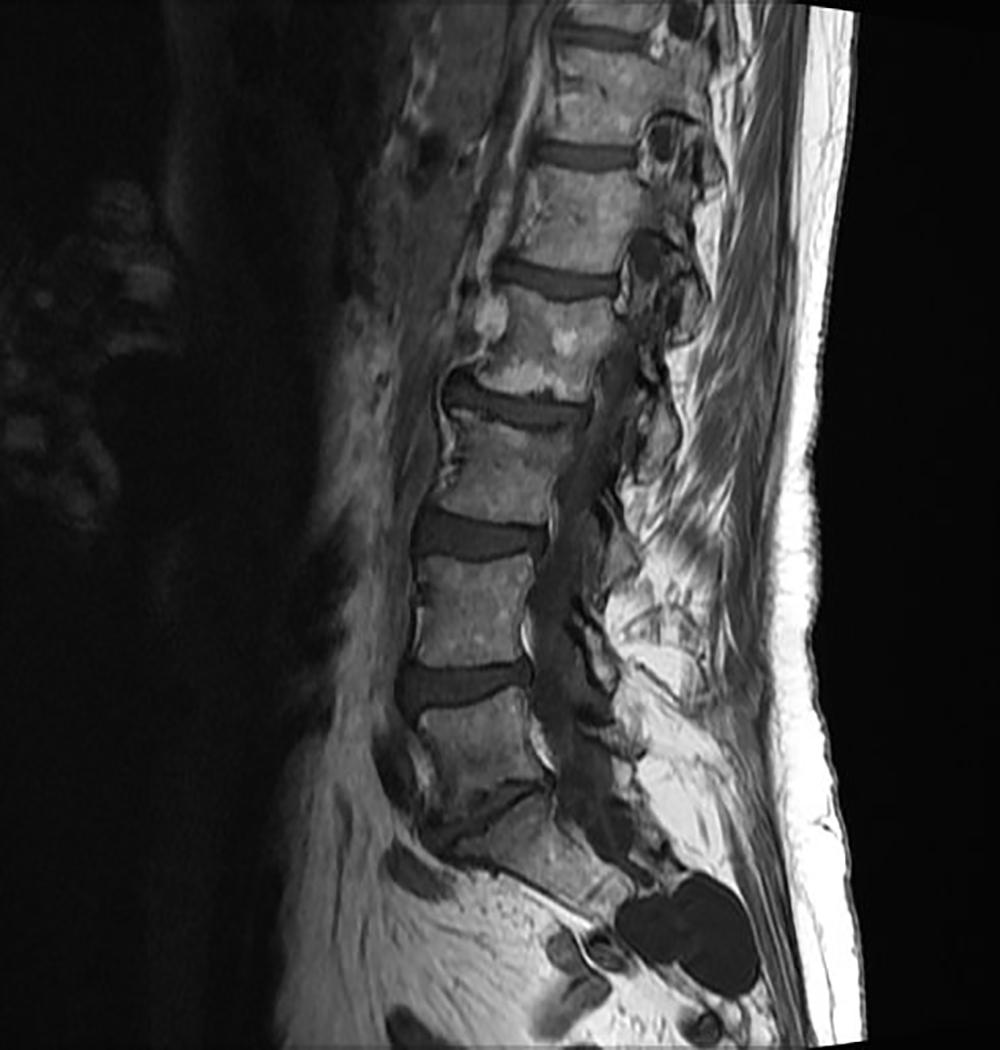 Fig. 158.2, A 62-year-old female patient had gradually increasing pain her coccyx and low back area. Symptoms waxed and waned for several months, and then exacerbated in June after gardening and pulling weeds. Imaging revealed multiple perineural cysts enlarging the sacral neural foramina.