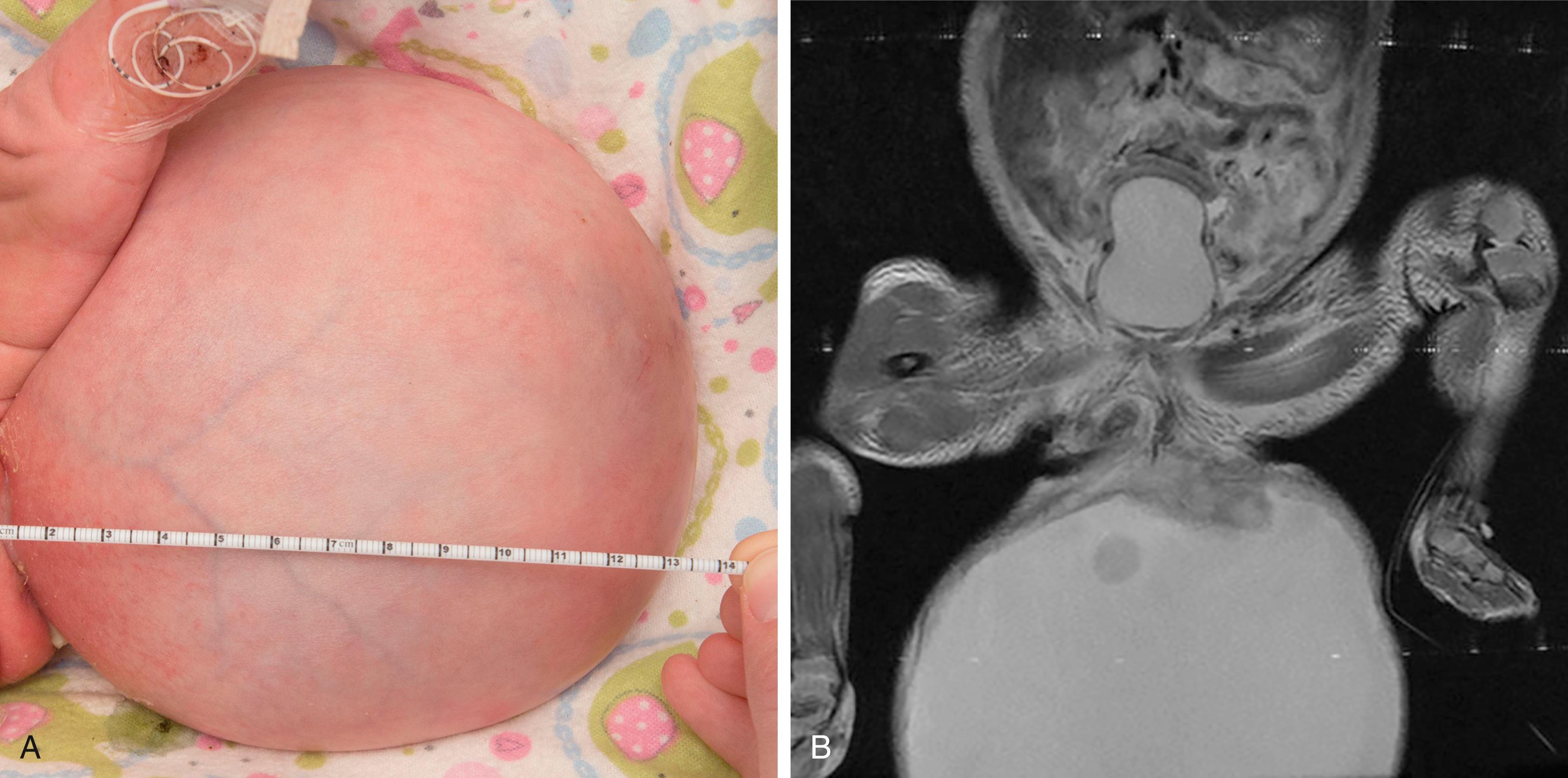 Fig. 158.3, A, Sacral teratoma in a newborn with multiple congenital abnormalities. B, Magnetic resonance imaging of the pelvis showing distended urinary bladder owing to compression, caused by teratoma.