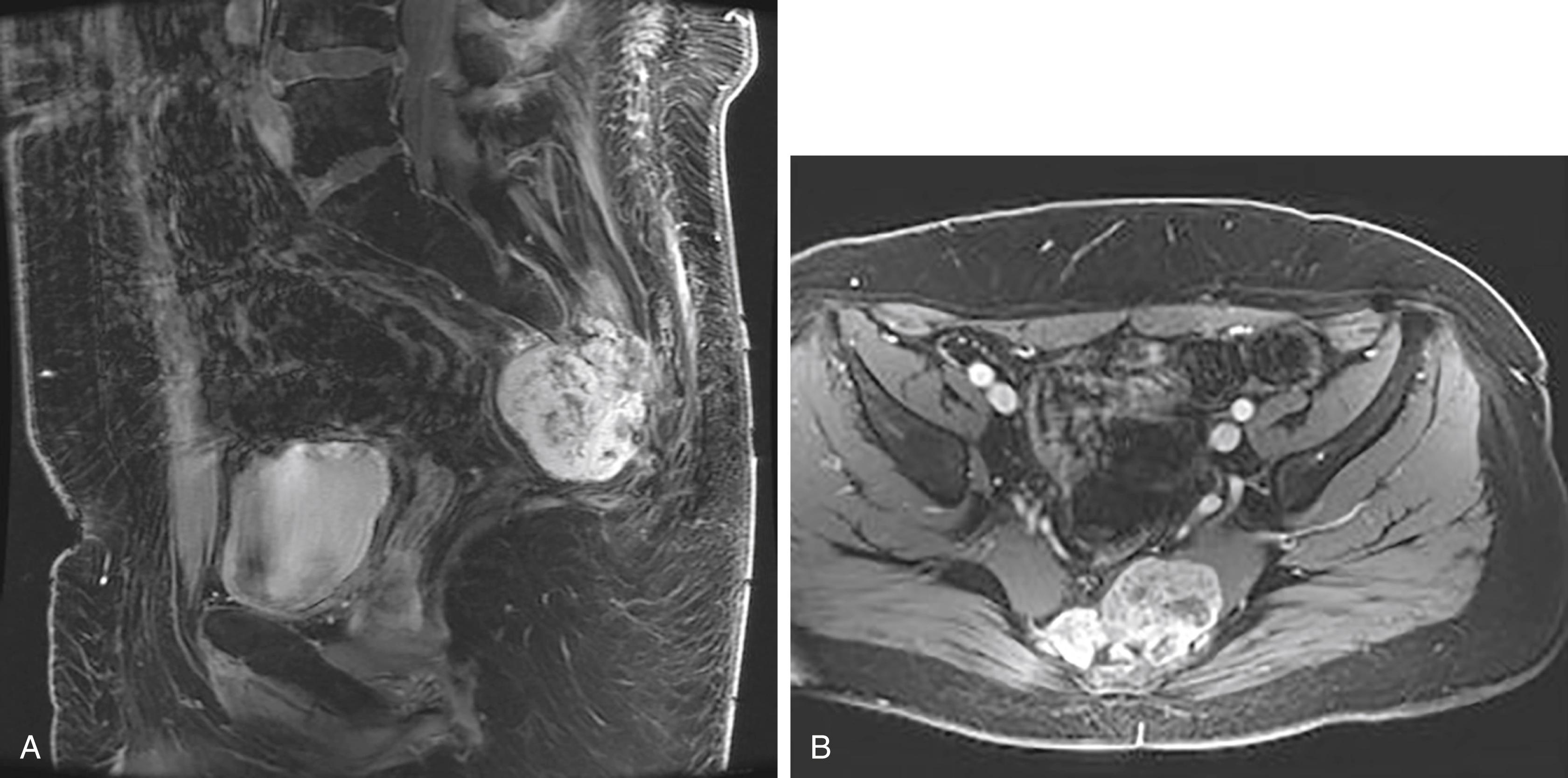 Fig. 158.4, A lobulated T1 hypointense, heterogeneously T2 hyperintense and avidly enhancing destructive sacral chordoma is seen in pelvic magnetic resonance imaging from ( A ) sagittal and ( B ) axial views.