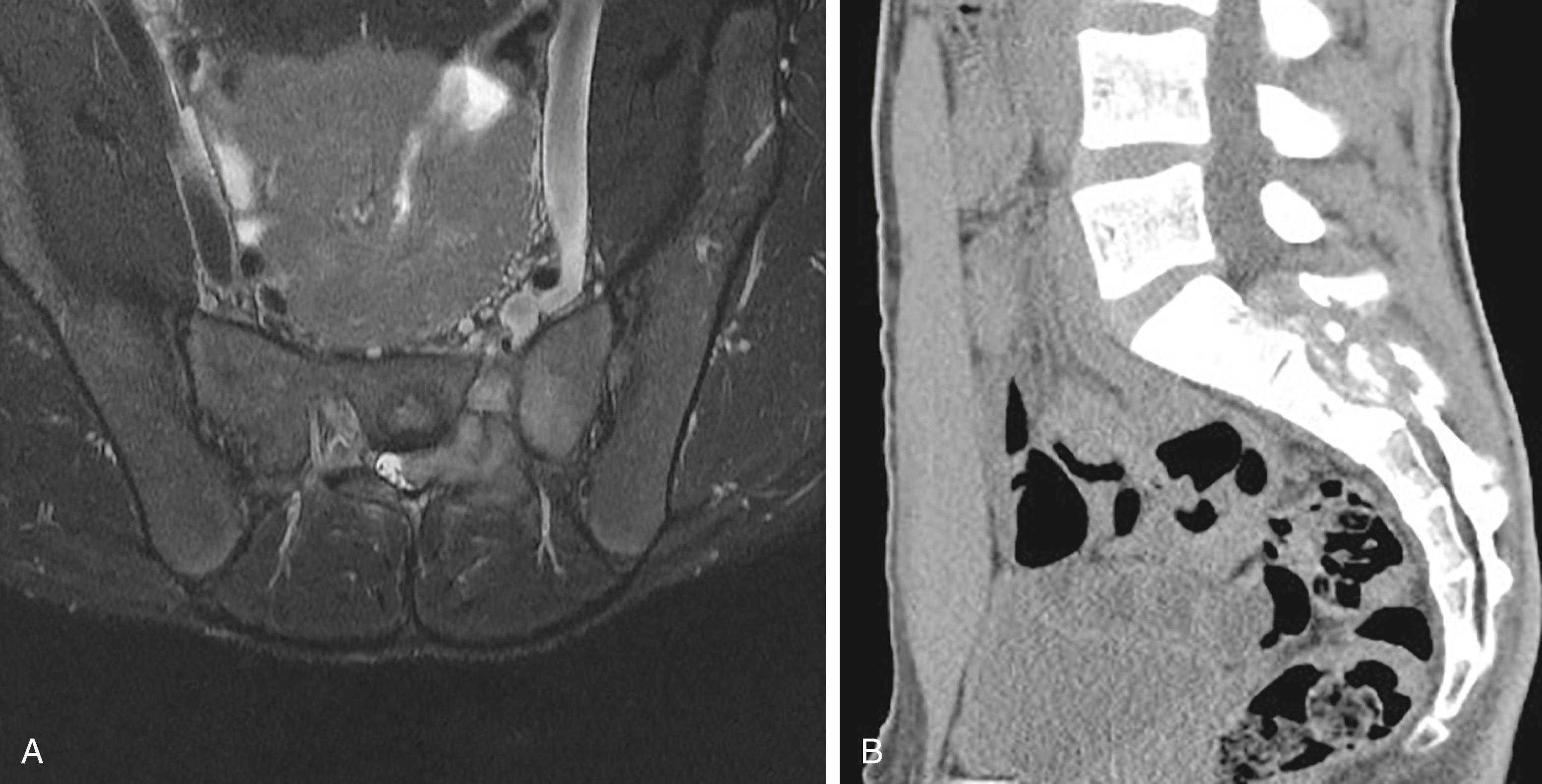 Fig. 158.5, A 17-year-old male patient presented to the clinic with a feeling of muscle sprain. Over a year, he developed weakness in his left leg, and imaging ( A, magnetic resonance imaging; B, computed tomography) of the pelvis revealed a sacral mass involving the S1 and S2 segments, as well as the upper part of S3. Erosion of the posterior margin of the S2 vertebral body and spinal canal infiltration were also noted. A diagnosis of osteoblastoma was made after histopathological examination.