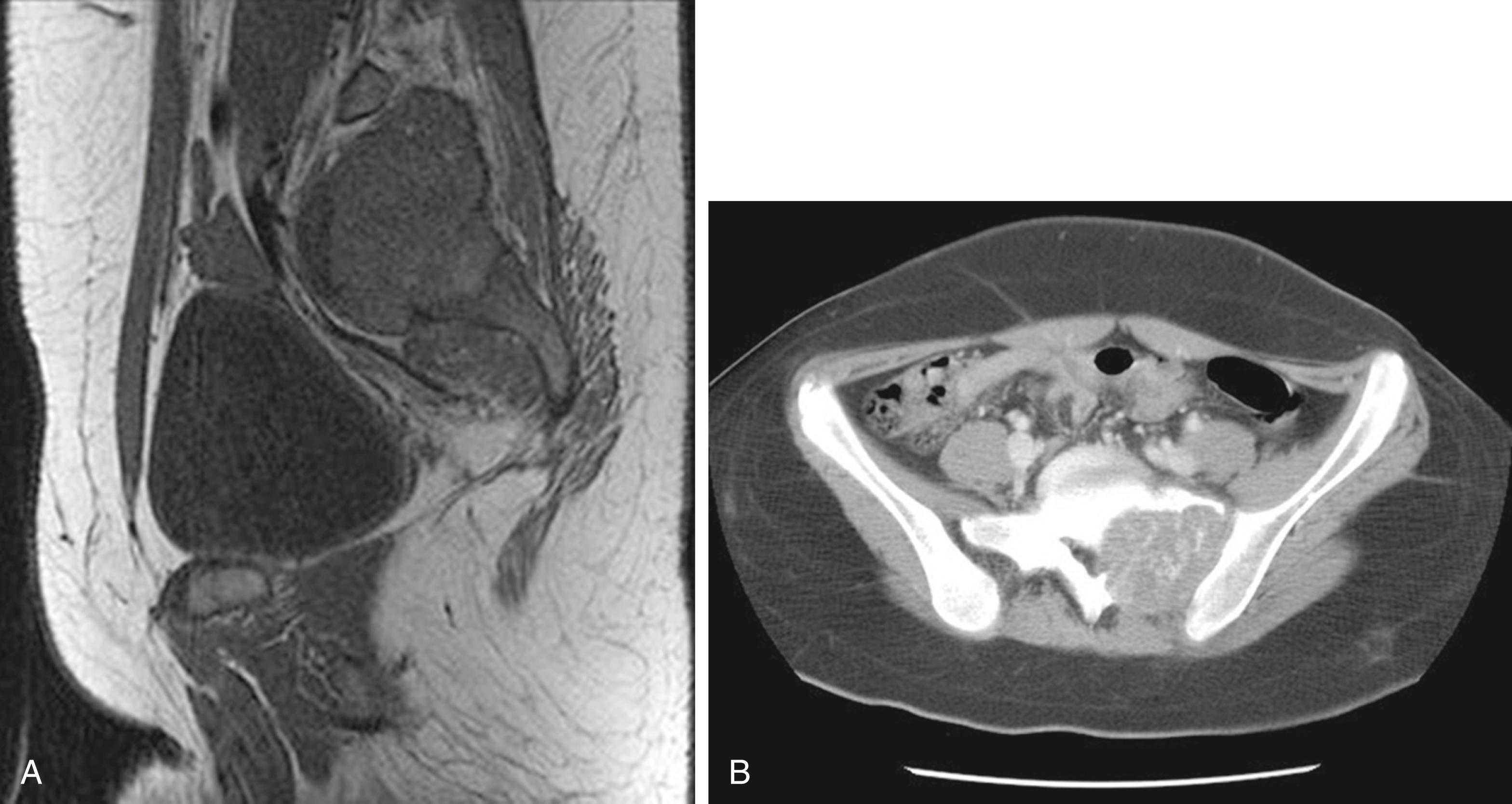 Fig. 158.6, A 13-year-old female patient, who was referred with a presumptive diagnosis of giant cell tumor of the sacrum, had approximately 2 months of left lower extremity radicular discomfort, specifically in the posterior buttock, thigh, and leg to the plantar lateral surface of the foot on the left. ( A ) Magnetic resonance imaging and ( B ) computed tomography (CT) of the pelvis showed a 5 × 5 cm destructive lesion involving the left side of the sacrum, with internal calcification. The mass was found to be extending into the spinal canal and involved the S1 and S2 neural foramen. CT-guided biopsy of the lesion confirmed a diagnosis of aneurysmal bone cyst.