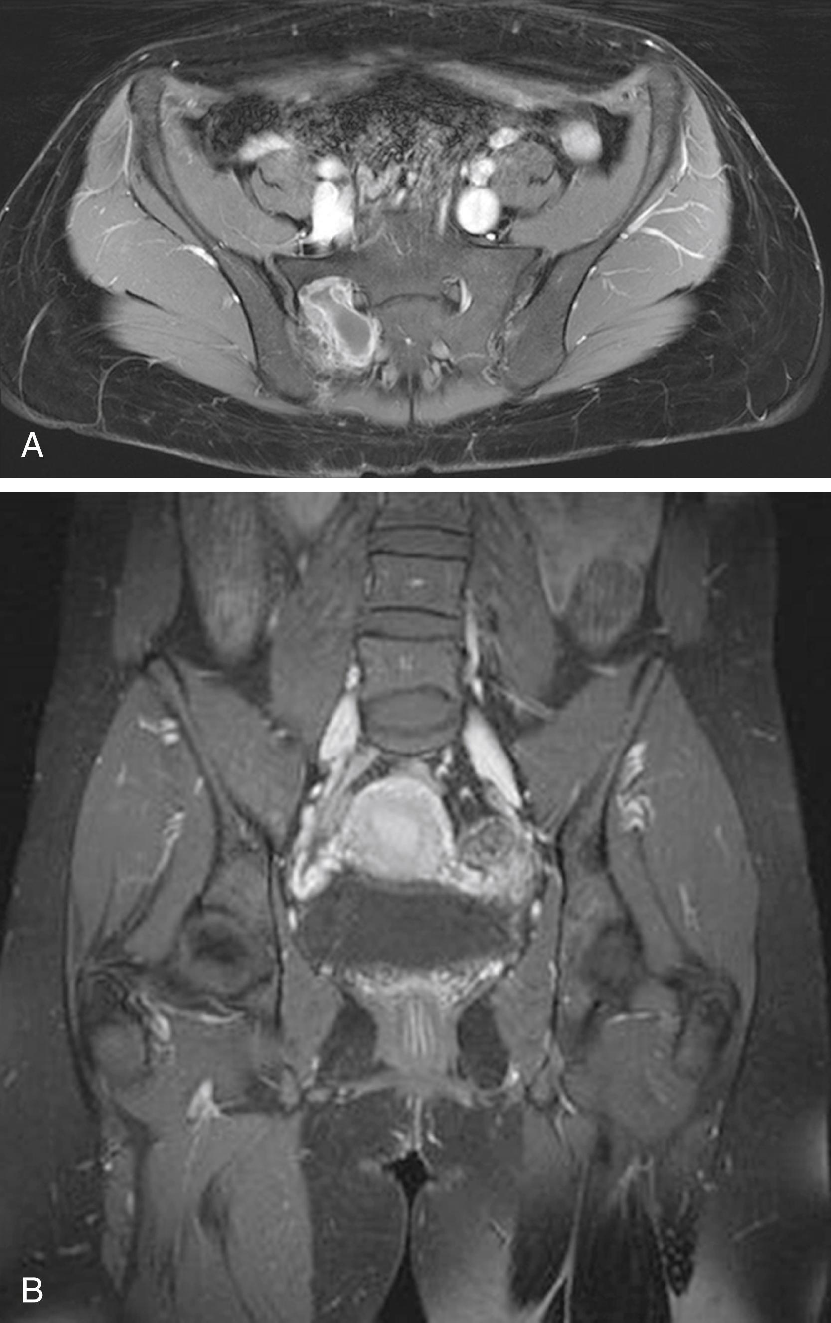 Fig. 158.7, Magnetic resonance imaging of the pelvis from ( A ) axial and ( B ) coronal views: Lobulated T1 hypointense, T2 hyperintense, heterogeneously enhancing mass within the right sacral ala measuring 4.3 × 3.4 × 3.0 cm. The mass is immediately adjacent to the right S1 nerve root. Pathology confirmed the diagnosis of a giant cell tumor.