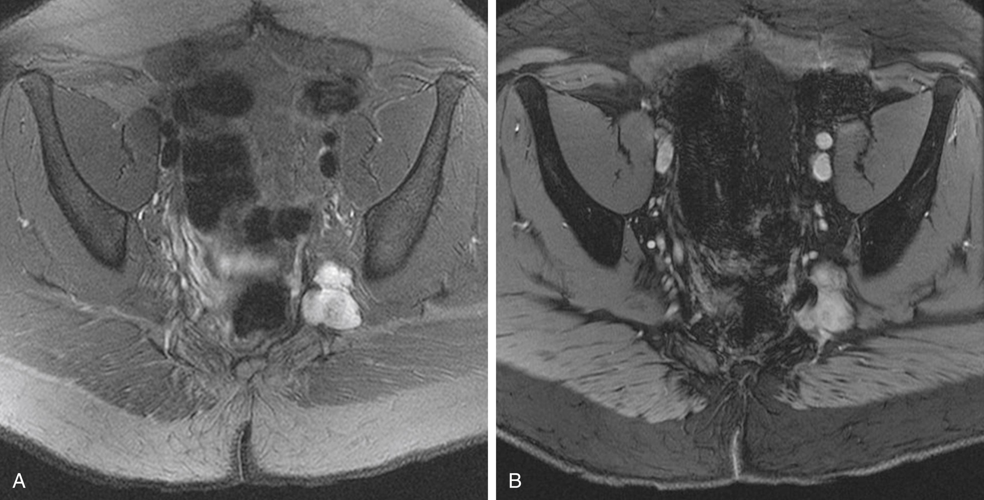 Fig. 158.9, A 13-year-old patient with stabbing pain in the left side of his penis that gradually spread to involve his left scrotum, left foot, and left leg. Magnetic resonance imaging of the pelvis identified a lobulated bilobed mass with increased ( A ) contrast enhancement and ( B ) T2 signal at the left sciatic notch arising from left L5 and S1 nerve roots. Pathology examination following the surgical resection confirmed a diagnosis of neurofibroma.