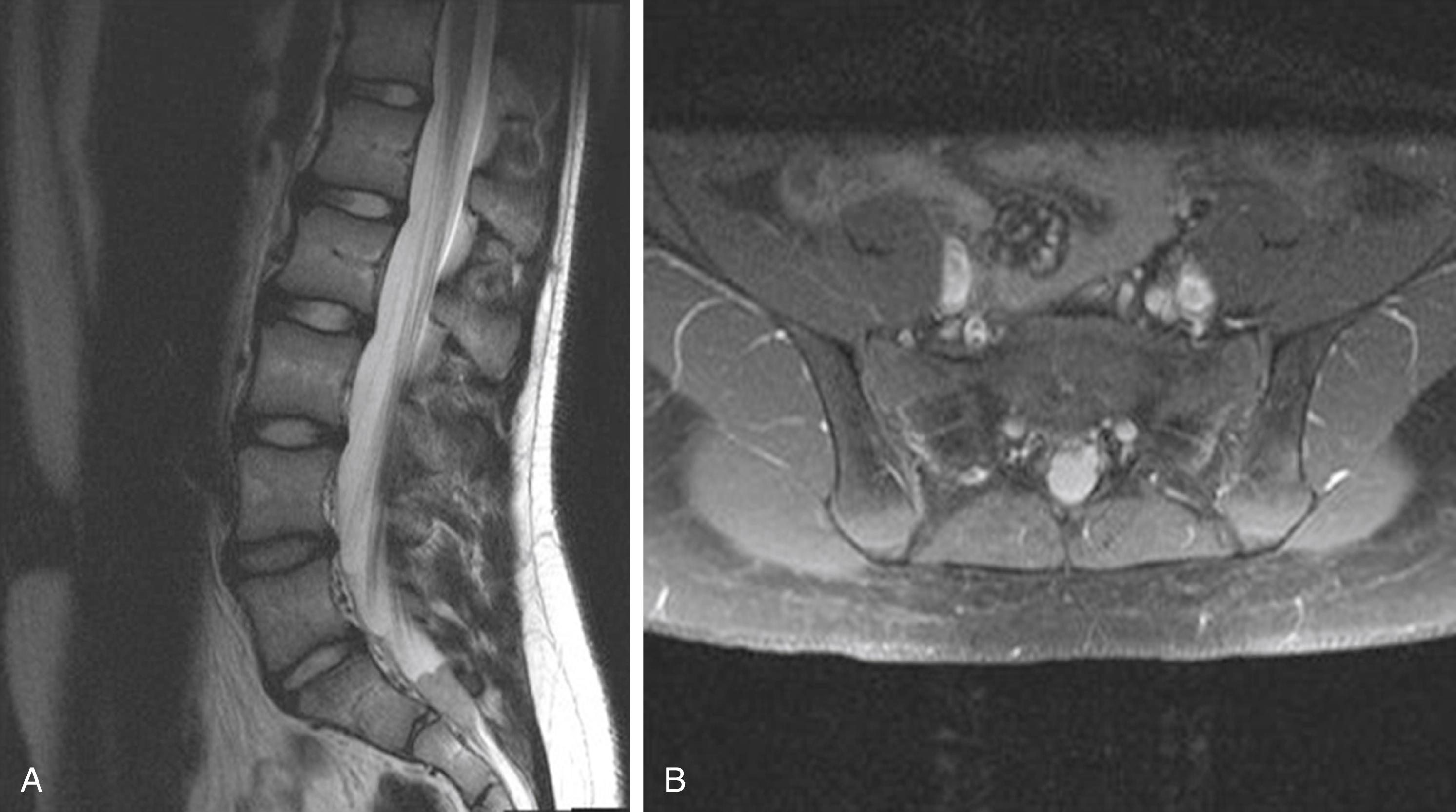 Fig. 158.10, Magnetic resonance imaging from ( A ) sagittal and ( B ) axial views showed an intradural mass at the S1-S2 level in a 13-year-old female. The tumor was removed following a sacral laminectomy and was found to be a myxopapillary ependymoma.