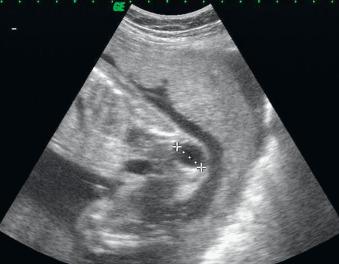 Fig. 31.2, Predominantly cystic SCT (type A) and normal bladder with completely internal component at 21 weeks' gestation. Vaginal delivery occurred, and the outcome was uneventful after complete surgical resection.