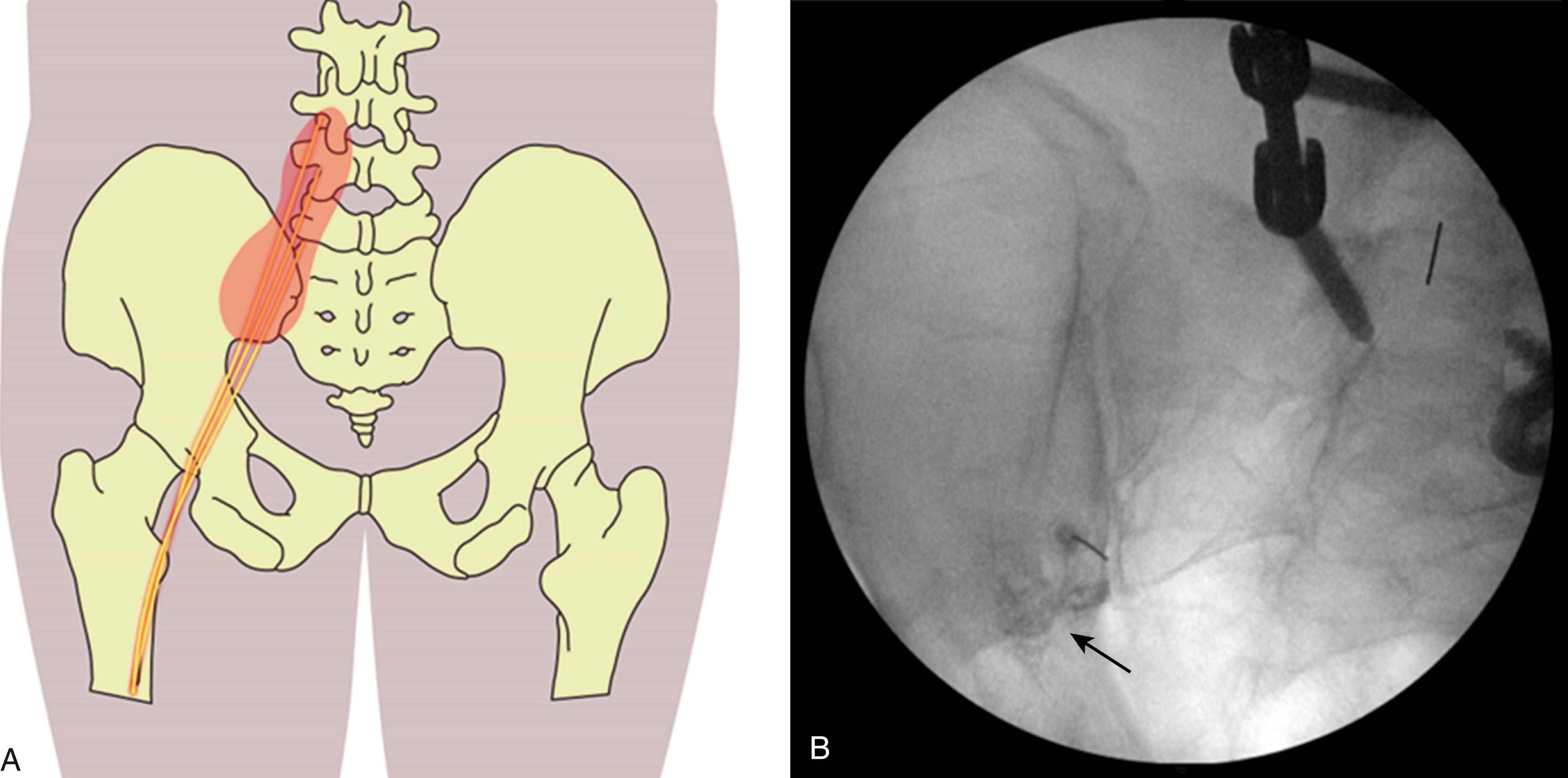 Fig. 140.2, Diagnosis of sacroiliac (SI) joint pain. A, SI joint symptoms include low back pain, buttock pain, groin pain, and/or pain radiating to the lower extremity, mimicking pathology from the lumbar spine and hip. B, Example of suboptimal diagnostic fluoroscopic SI joint injection. Medication/contrast ( arrow ) pools anterior to the SI joint and likely affects the traversing lumbosacral plexus, limiting diagnostic capability for SI joint pathology.