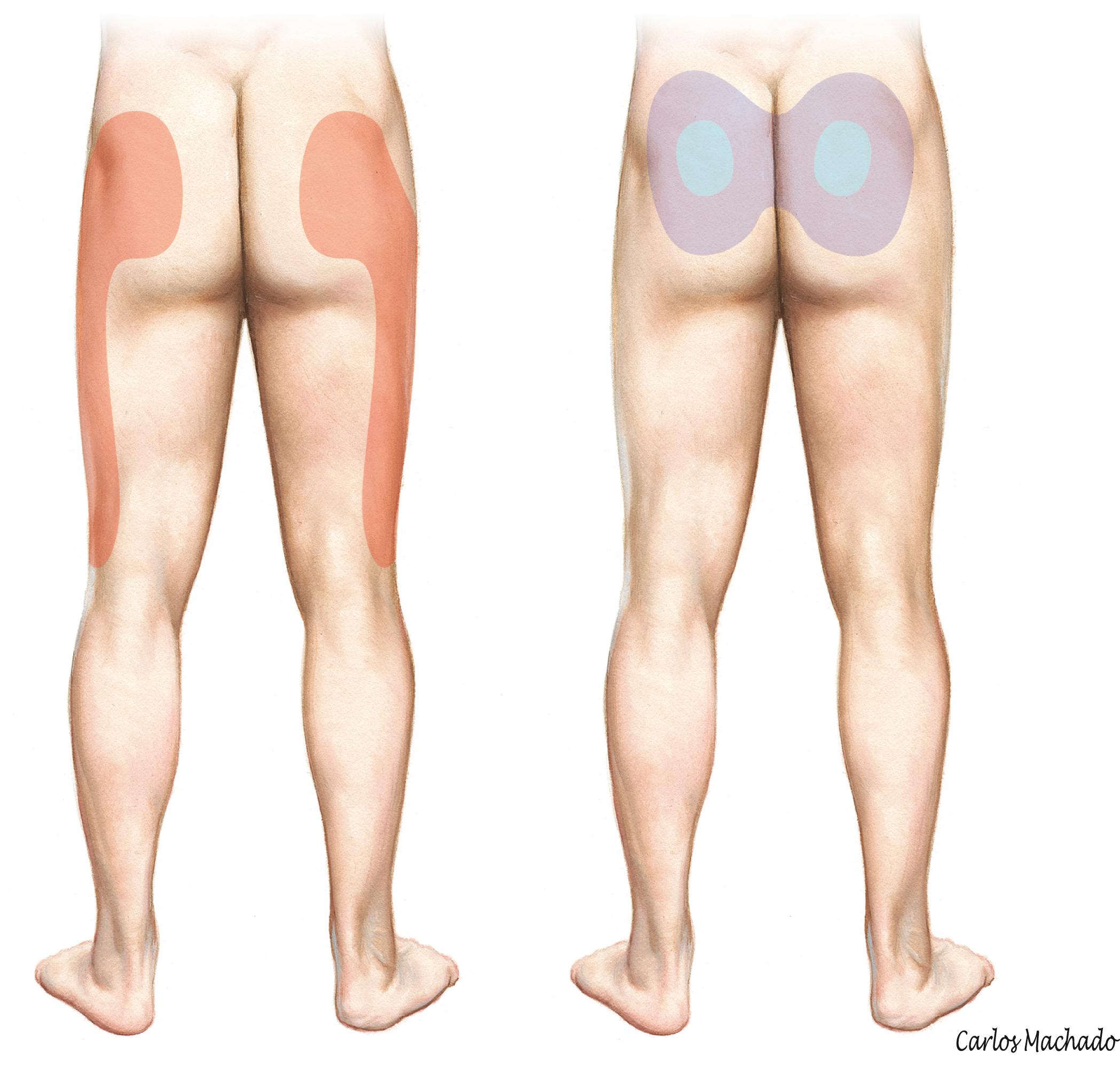 Figure 5-10, Jung and associates 12 determined the most common pain distribution patterns in patients with sacroiliac joint pain. They then prospectively tested the ability of the pain distribution patterns to diagnose the response to sacroiliac joint radiofrequency neurotomies in 160 patients with presumed sacroiliac joint pain. The pain distribution patterns with the best diagnostic utility are depicted, with colors representing pain intensity (scale, 1-5). Left, red = 4; right, blue = 5, purple = 4.