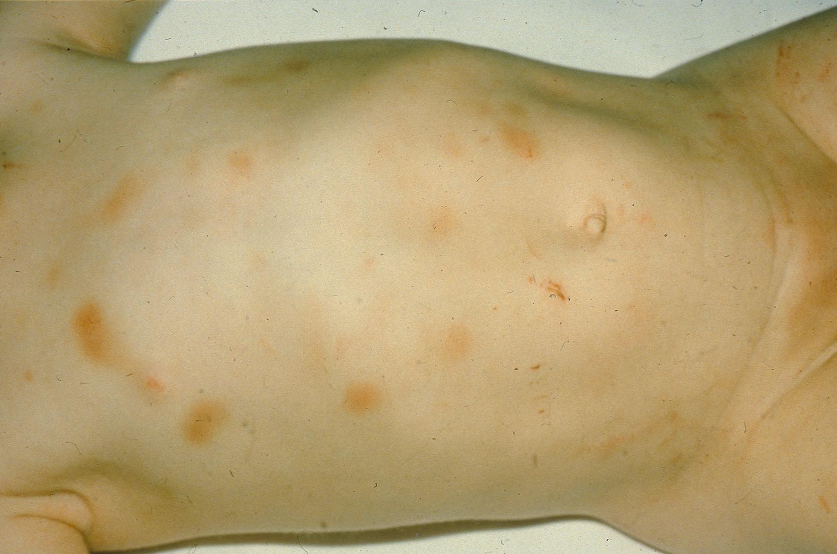 Figure 11.1, Abnormal bruising on anterior surface of chest and abdomen suggesting physical abuse.