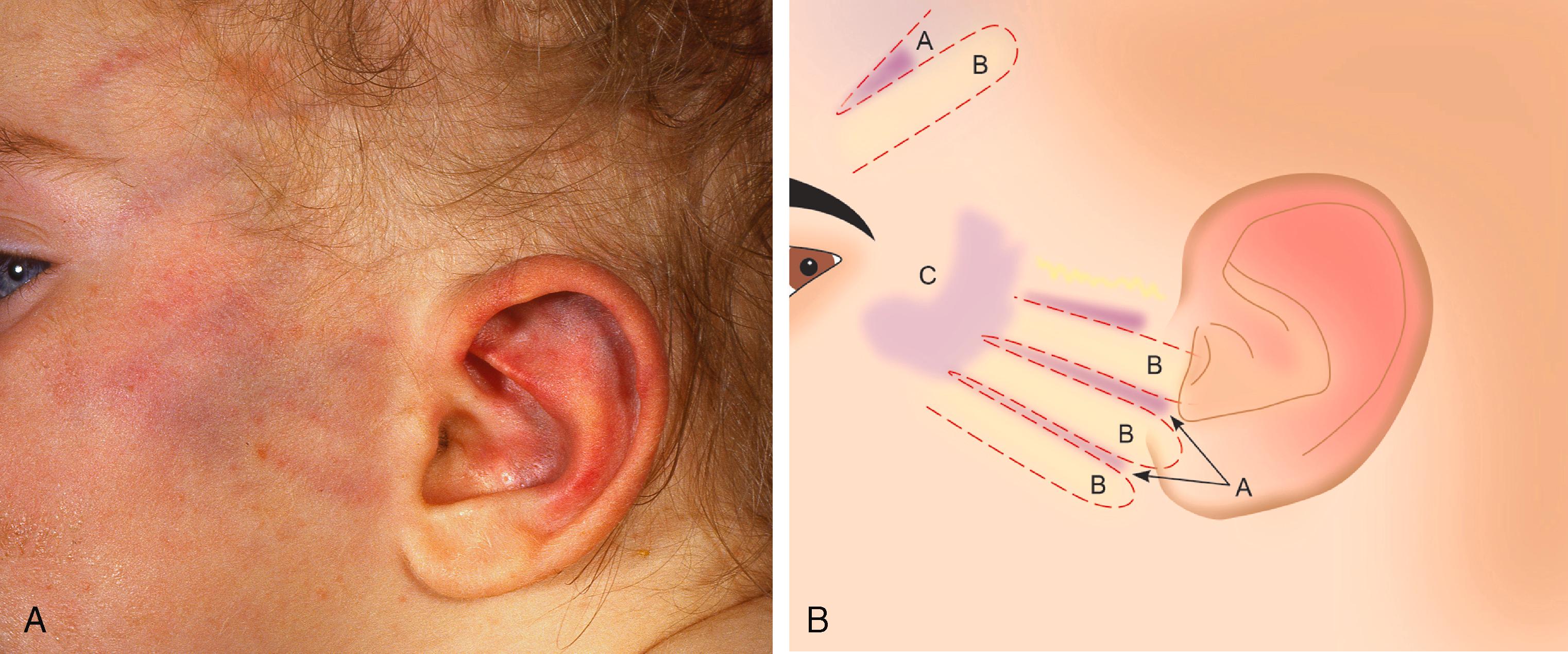 Figure 11.2, A and B. These figures show bruises caused by slap on the face. The ear is bruised. The obvious linear bruises (A) are caused by gap between the fingers allowing capillaries to burst whilst the adjacent paler areas (B) show the impact area of the fingers. The larger bruise (C) is created by the palm of the hand.