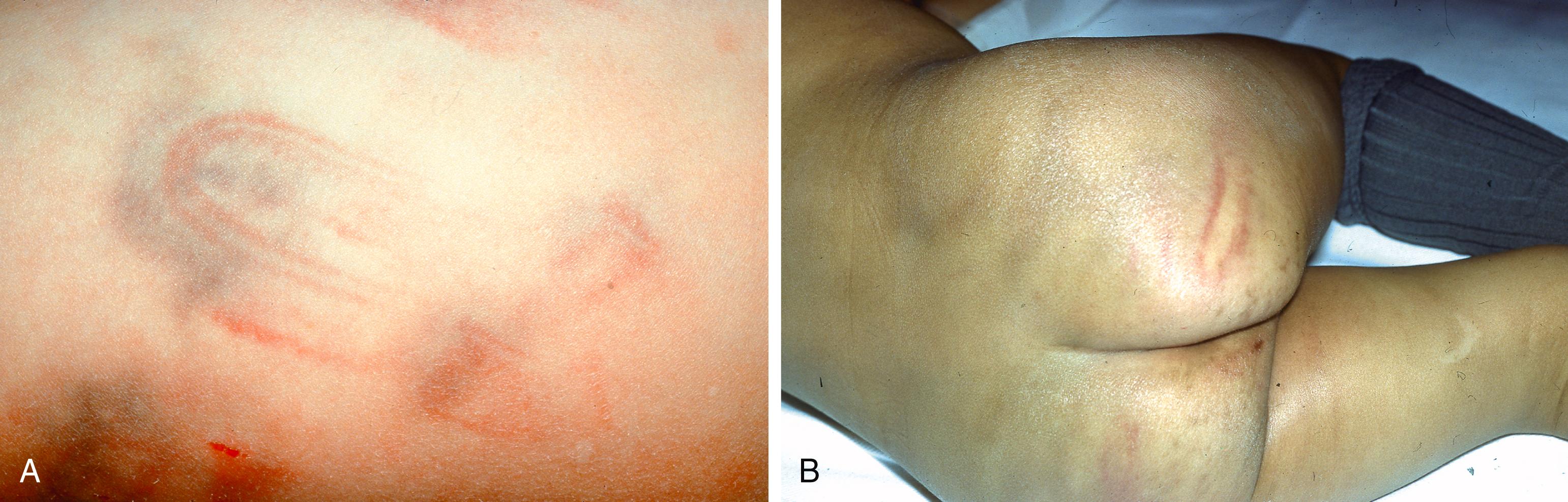 Figure 11.3, A and B. Images shows bruise cause by blows from a belt. The image of the buckle is evident in (A) and the belt pattern in (B).