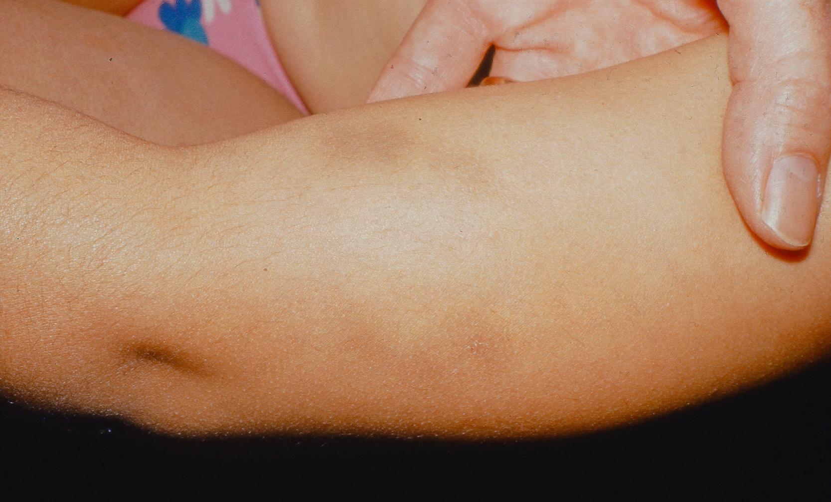 Figure 11.4, This image shows bruise caused by adult bite mark.