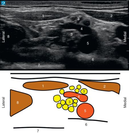 FIGURE 74.1, A pre-block survey sonogram obtained prior to a supraclavicular brachial plexus block identified a large arterial structure between the neural elements of the brachial plexus. (1) Omohyoid muscle; (2) sternocleidomastoid muscle; (3) brachial plexus; (4) dorsal scapular artery; (5) subclavian artery; (6) first rib; (7) pleura; (8) scalenius medius muscle.