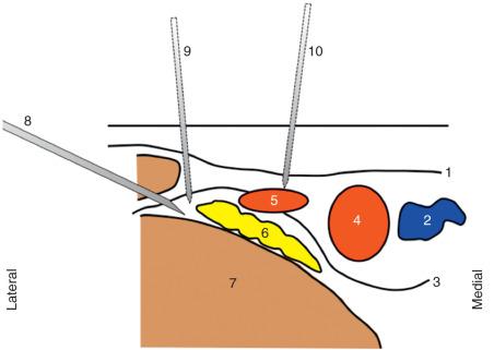 FIGURE 74.2, Examples of trajectories and relative risk of vascular injury during femoral block are illustrated. (1) Fascia lata; (2) femoral vein; (3) fascia iliaca; (4) femoral artery; (5) circumflex artery (femoral); (6) femoral nerve; (7) iliopsoas muscle; (8) lateral to medial in-plane approach; (9) out-of-plane approach; (10) out-of-plane approach too medial.