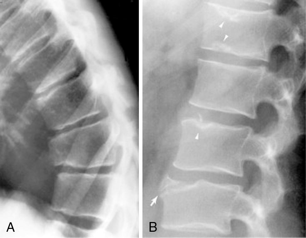Fig. 41.1, Scheuermann disease. (A) Thoracic spine lateral radiograph. Findings include irregularity in vertebral contour, reactive sclerosis, intervertebral disc space narrowing, anterior vertebral wedging, and kyphosis. (B) Lumbar spine lateral radiograph. Observe the cartilaginous nodes (arrowheads) creating surface irregularity, lucent areas, and reactive sclerosis. Anterior disc displacement (arrow) has produced an irregular anterosuperior corner of a vertebral body, which is termed a limbus vertebra .