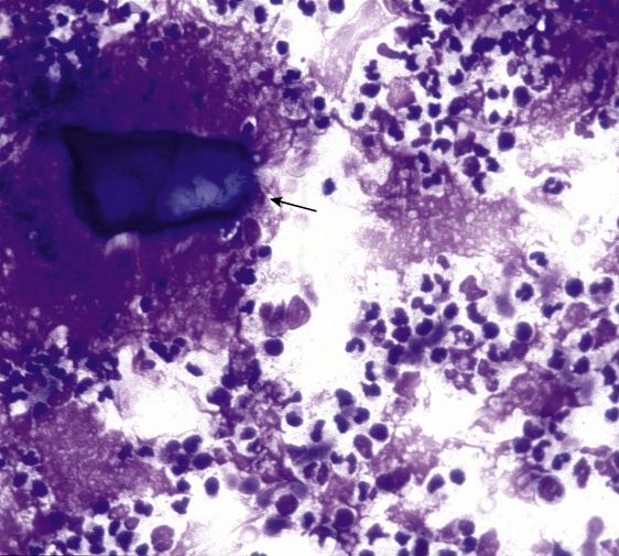 Fig. 11.3, Sialolithiasis with Acute Sialadenitis.