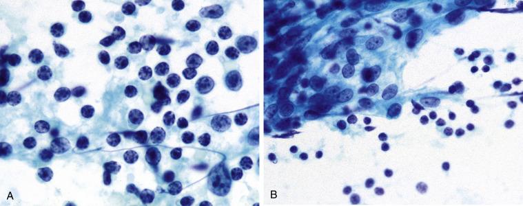 Fig. 11.5, Lymphoepithelial Sialadenitis.