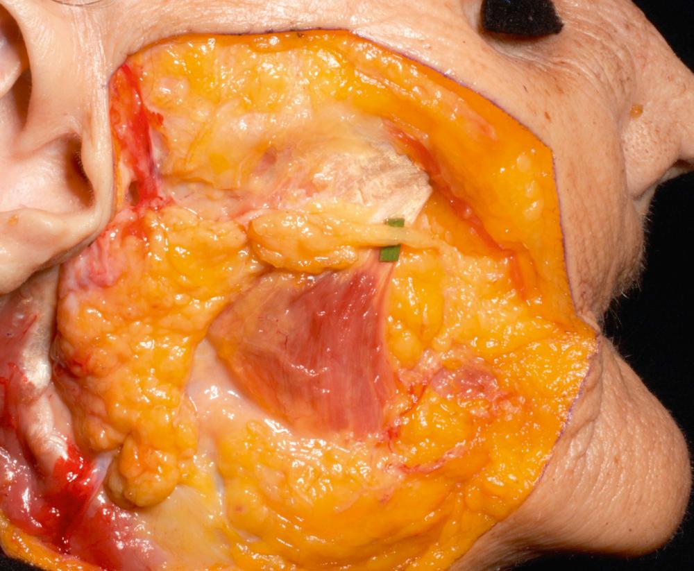 Fig. 1.4, The parotid gland with Stensen's duct (green marker). Inferior to Stensen's duct and anterior to the parotid gland is the masseter muscle.