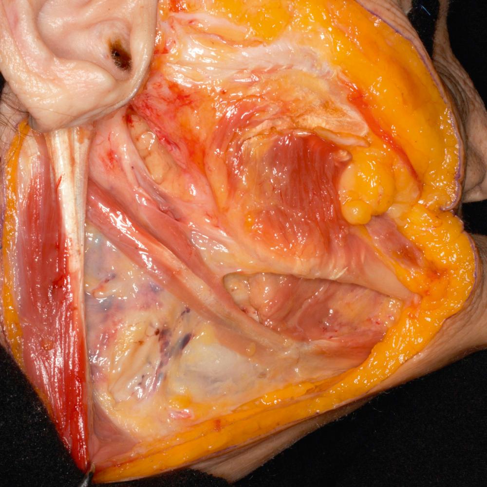 Fig. 1.5, The parotid gland is removed: anteriorly, the mandible and masseter muscle; posteriorly, the external auditory canal and the retracted sternocleidomastoid muscle; the inferior pole of the parotid overlies the digastric muscle.