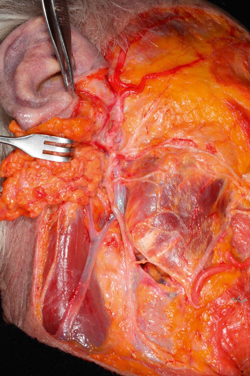 Fig. 1.7, The parotid gland is retracted posteriorly, with blood supply to the parotid gland from the postauricular artery and superficial temporal artery; both branches of the external carotid artery. The retromandibular vein joins the external jugular vein via the posterior facial vein. The retromandibular facial vein can join the anterior facial vein that joins the internal jugular vein.