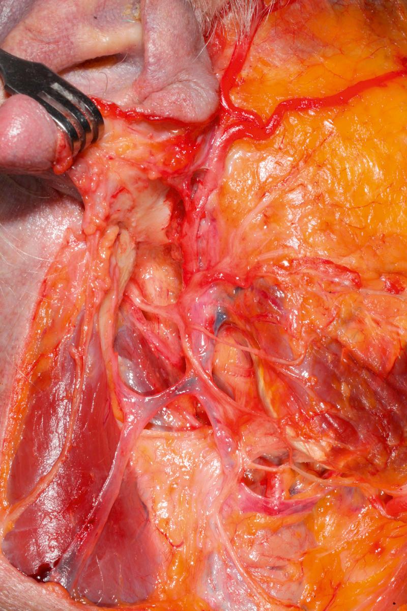 Fig. 1.8, The external carotid artery gives rise to the maxillary artery, postauricular artery, and superficial temporal artery, that gives rise to the transverse facial artery. The facial nerve, pes anserinus, and peripheral branches are noted superficial to the external carotid artery. The tympano-mastoid suture can be visualized just superior to the pes anserinus of the facial nerve.