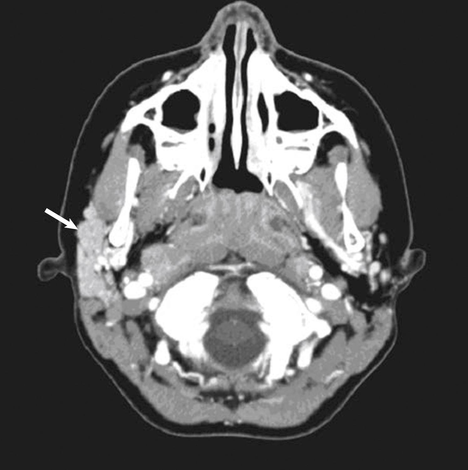 Fig. 24.5, Axial computed tomography scan with contrast demonstrating unilateral agenesis of the left parotid gland. The arrow points to the normal parotid gland on the contralateral side.