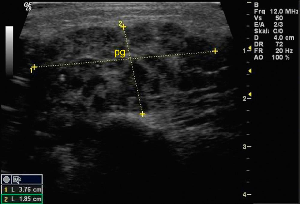 Fig. 3.2.8, The ultrasound of this parotid gland (pg) shows signs of a chronic inflammatory process with multiple hypoechoic lesions. This pattern can be seen in Sjögren syndrome or in chronic recurrent juvenile parotitis. In this case it was the latter one.