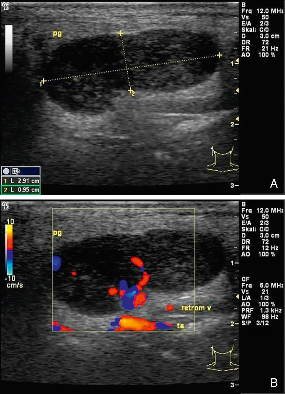 Fig. 3.2.9, A Warthin tumor in the right parotid gland. (A) The tumor is hypoechoic and well-circumscribed. Note the distal acoustic enhancement. (B) With color Doppler (duplex mode), hypervascularization can infrequently be observed. In this case it made it difficult to distinguish the tumor from a lymph node as the vascularization in this case mimics a lymph node hilum. pg, parotid gland; retrom v, retromandibular vein; ta, temporal artery.