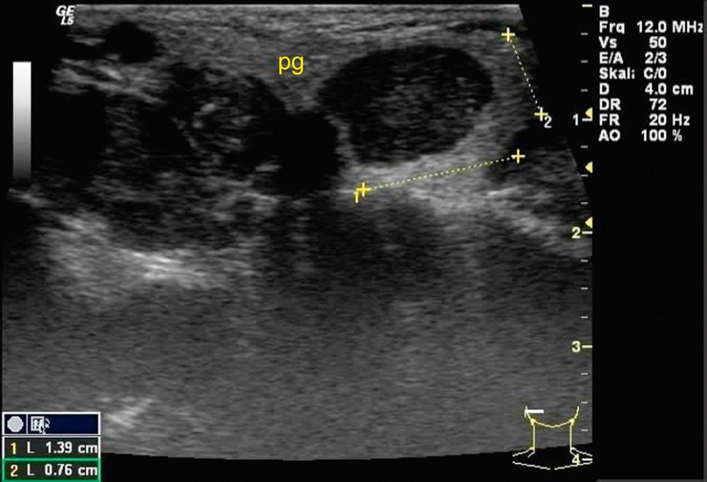 Fig. 3.2.10, Pleomorphic adenoma of the right parotid gland (pg): the lesion is hypoechoic with a distal echo enhancement. It frequently presents with lobulated but well-defined borders.