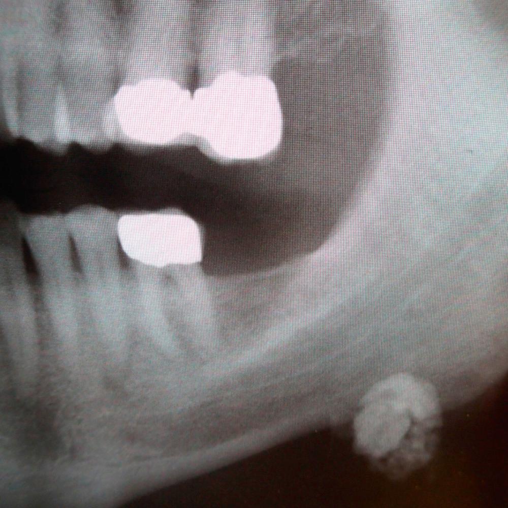 Fig. 3.1.2, Dental X-ray with an incidental finding of a sialolith in the left submandibular gland.