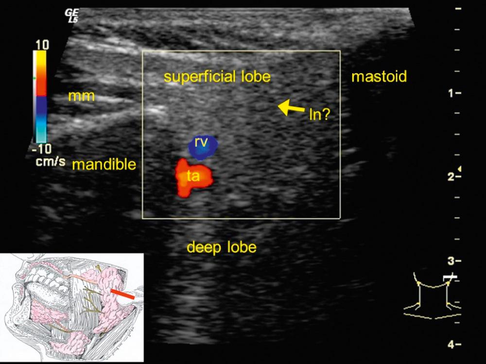 Fig. 3.2.1, Ultrasound anatomy of the parotid gland: the retromandibular vein (rv) is often at the depth of the facial nerve and therefore divides the deep from the superficial lobe. The temporal artery (ta) lies even deeper than the vein. mm, masseter muscle; ln, lymph node.