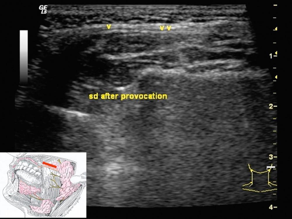 Fig. 3.2.2, Stensen's duct is normally not visible by ultrasound. However, provocation of salivary production by use of a sialagogue (e.g., ascorbic acid) can dilate the Stensen's duct (sd, v arrowheads). Deep to the duct, the masseter muscle is visible.