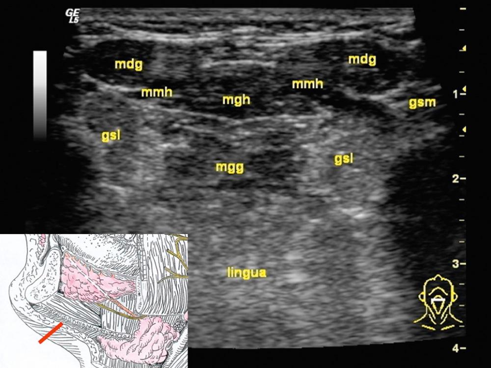 Fig. 3.2.6, The transverse view of the floor of the mouth includes the sublingual gland (gsl); the mylohyoid muscle (mmh); the anterior belly of the digastric muscle (mdg); the genioglossal muscle (mgg); the geniohyoid muscle (mgh); and the tongue (lingua). Sometimes even in front, accessory parts of the submandibular gland (gsm) can be found.