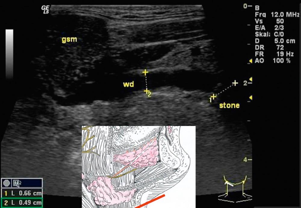 Fig. 3.2.7, A stone obstructs Wharton's duct (wd) of the right submandibular gland (gsm). The dilated duct is in direct contact with the sublingual gland (the gray area on the image above the duct, just left and above the stone). Note the different echogenity of the sublingual gland (normal echotexture for a salivary gland, similar to the thyroid gland) and of the swollen submandibular gland (less echogenity). An acute infection of the gland can lead to a similar loss of echogenity due to edematous swelling.