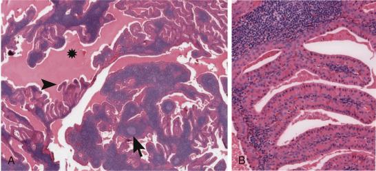 Fig. 43.1, Warthin Tumor and Warthin-Like Mucoepidermoid Carcinoma.