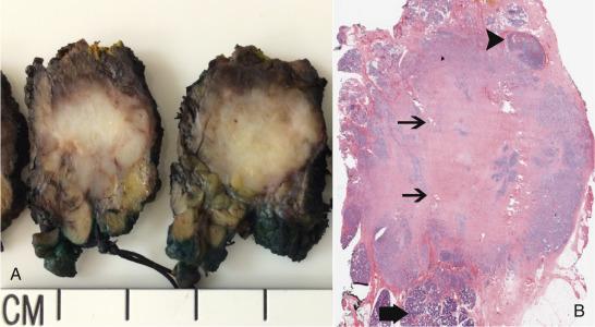 Fig. 43.2, Salivary Duct Carcinoma Ex-Pleomorphic Adenoma.