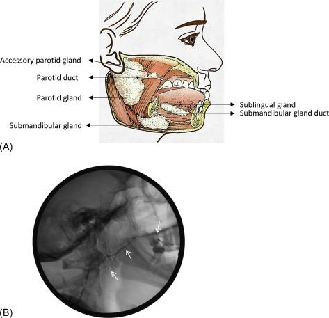 Fig. 37.1, Anatomic distribution of salivary glands in the head and neck region. (A) Diagram showing positions of glands. (B and C) Sialograms showing ductal structure of parotid gland and submandibular gland. Arrows indicate orifices and position of main ducts (Stenson’s and Wharton’s) and branching “tree” structure of inter- and intralobular ducts in glands. (D) Photograph showing the distribution of minor salivary glands under the mucosa of the lower lip; beads of saliva appear above the ducts of each minor salivary gland (arrow).