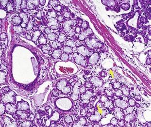 Fig. 37.5, Histology of the sublingual glands showing predominance of mucinous acini. Note that the occasional presence of adipocytes (arrows) , a feature found in older individuals.