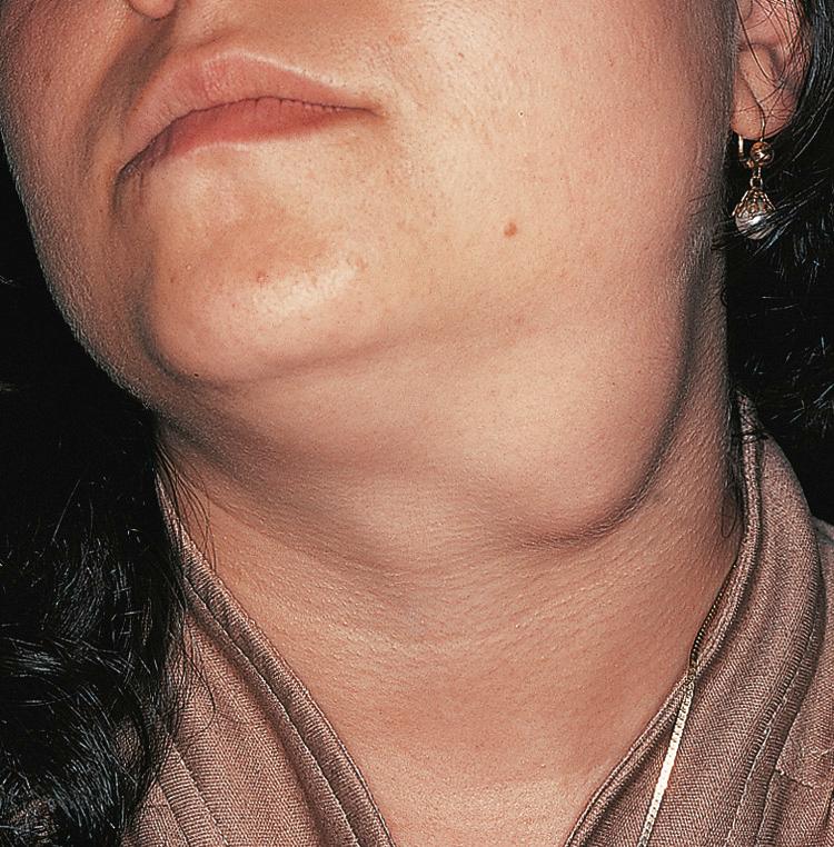 Figure 13.15, A mixed tumor of the submandibular salivary gland.