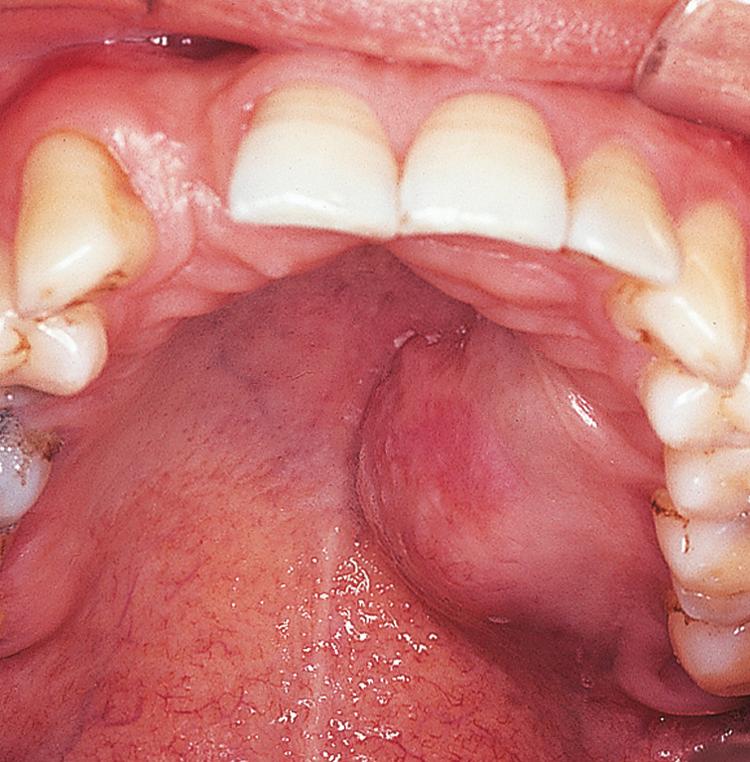 Figure 13.16, An adenoid cystic carcinoma of the hard palate.