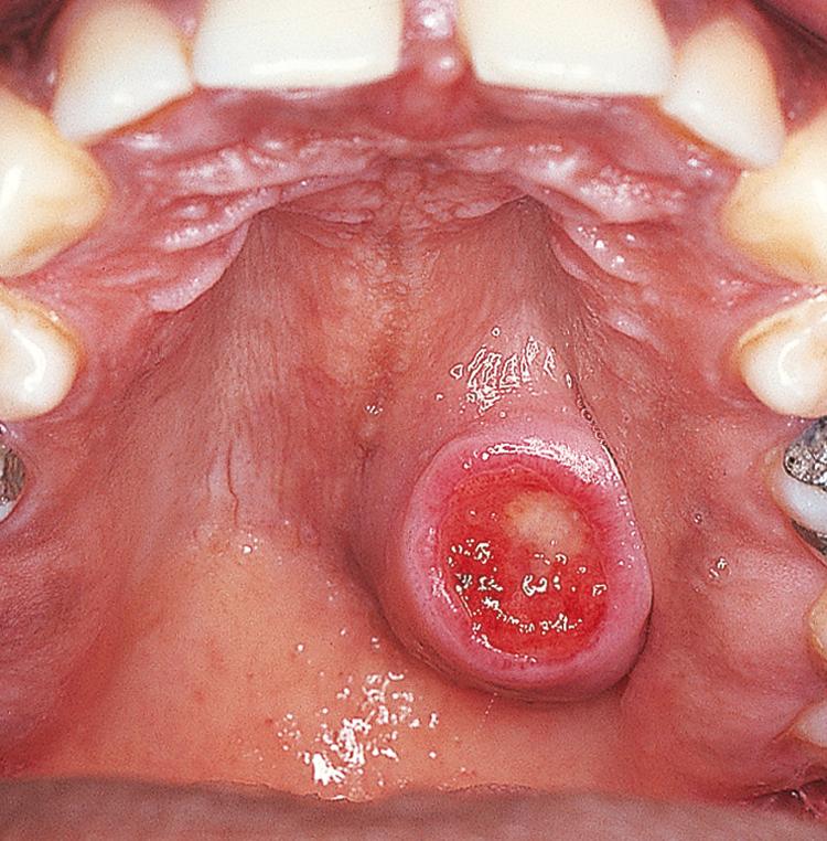 Figure 13.17, A malignant mixed tumor of the hard palate.