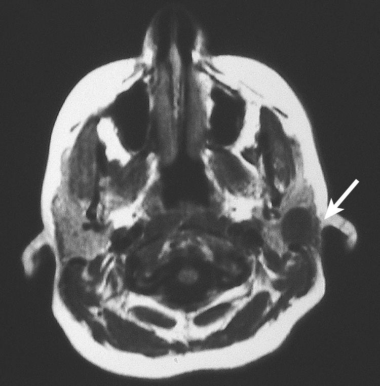 Figure 13.20, A T1-weighted magnetic resonance imaging scan showing a benign mixed tumor in the superficial lobe of the left parotid gland ( arrow ).