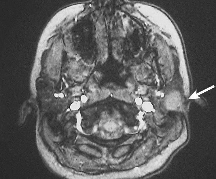 Figure 13.21, A T2-weighted magnetic resonance imaging scan showing a benign mixed tumor in the superficial lobe of the left parotid gland ( arrow ).