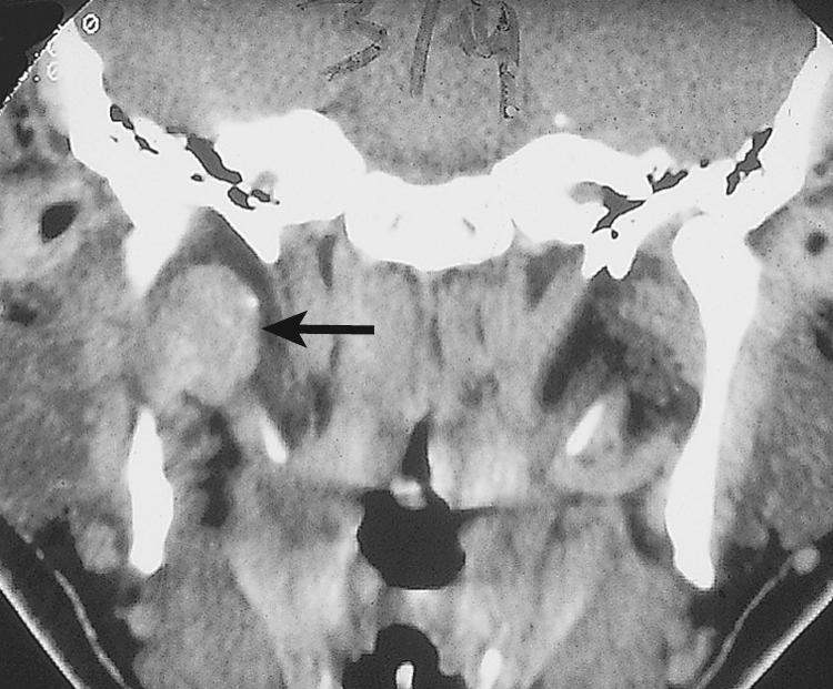 Figure 13.23, A coronal view of the computed tomography scan of the same patient as in Fig. 13.20 showing the deep lobe parotid tumor ( arrow ).