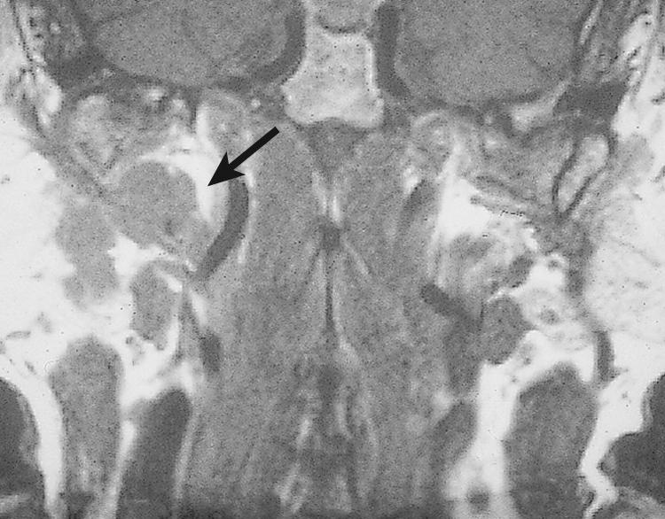 Figure 13.25, A coronal view of the magnetic resonance imaging scan of the same patient as in Fig. 13.20 showing the deep lobe parotid tumor ( arrow ).