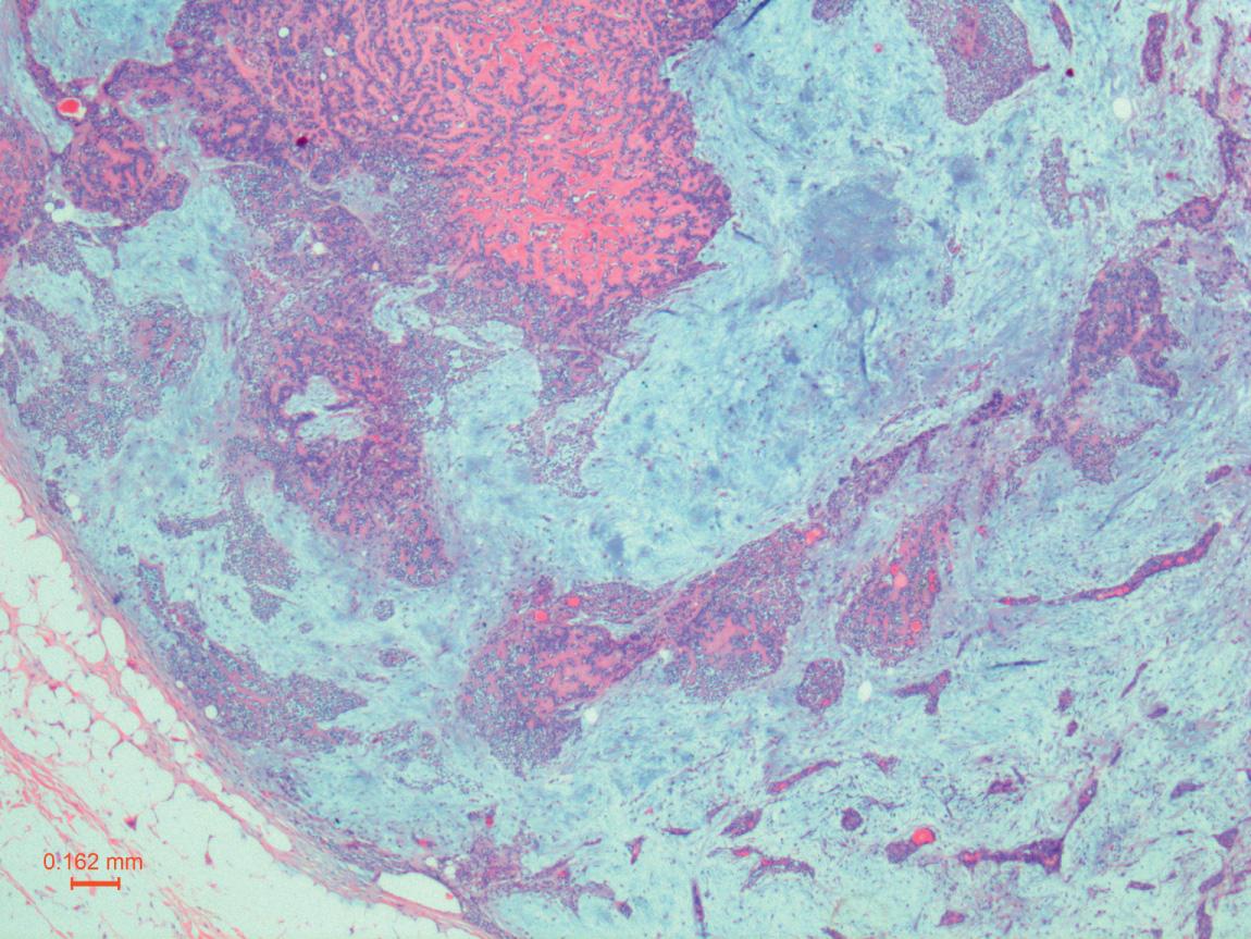 Figure 13.28, Pleomorphic adenoma demonstrating abundant myxochondroid matrix and myoepithelial cells (25× H&E stain).