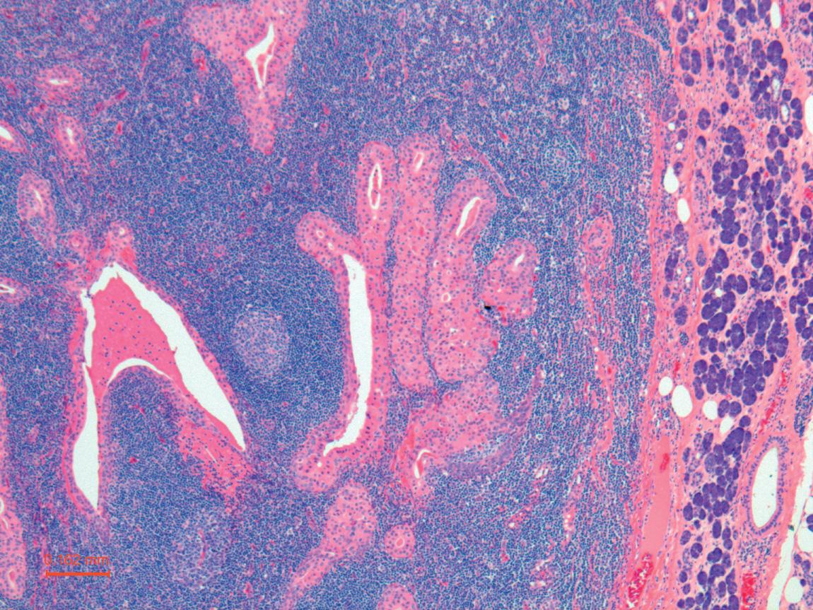 Figure 13.30, Warthin's tumor with adjacent normal parotid gland parenchyma on the right (50× H&E stain).