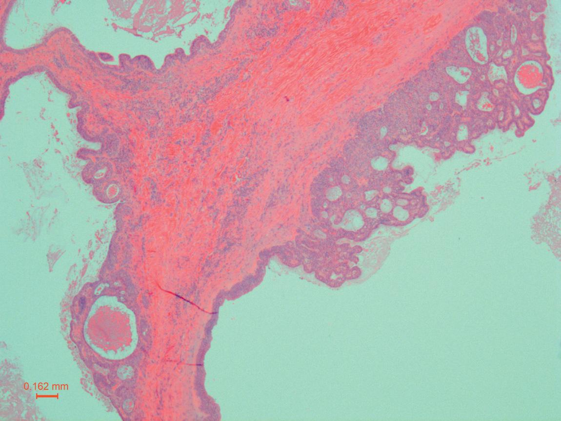 Figure 13.32, Low-grade mucoepidermoid carcinoma with more than 20% of the tumor represented by cystic spaces lined by squamoid epithelial cells (25× H&E stain).