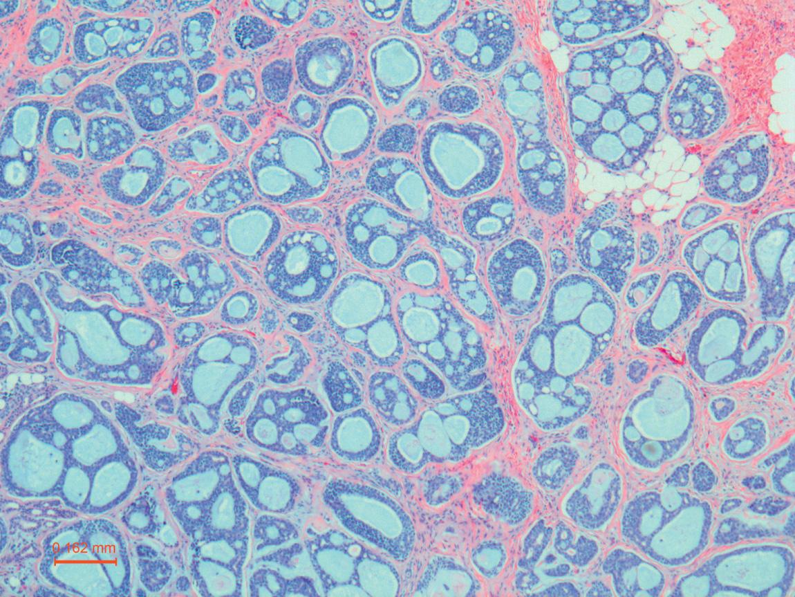 Figure 13.34, Adenoid cystic carcinoma of the parotid gland demonstrating a predominantly cribriform architectural pattern (50× H&E stain).